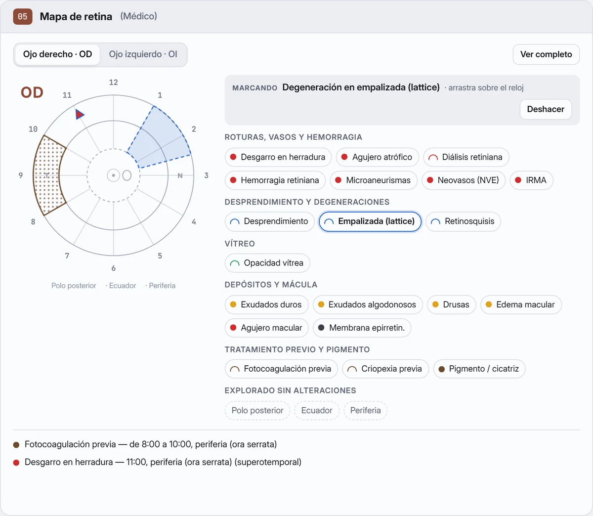 Pantalla de iGalenus con el mapa de retina del ojo derecho: esquema con las horas del reloj y tres zonas, y hallazgos por categoría para marcar. Captura con datos de demostración.